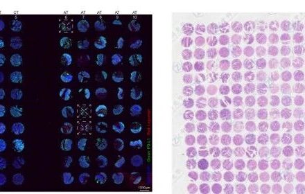 什么是组织芯片？病理界的 “压缩包革命”来了！_组织芯片网